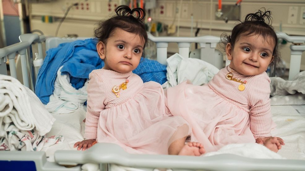 Conjoined twins successfully separated in a rare surgery at Seattle Children's Hospital