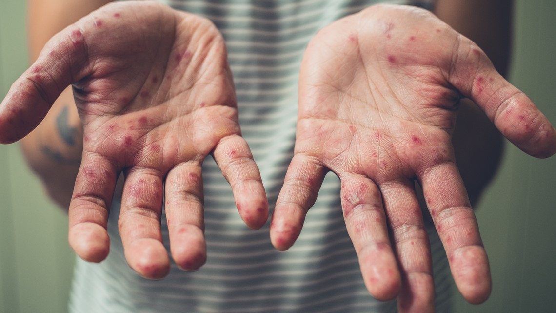 Delaware County issues health alert due to outbreaks of hand, foot, and mouth disease. Stay safe!