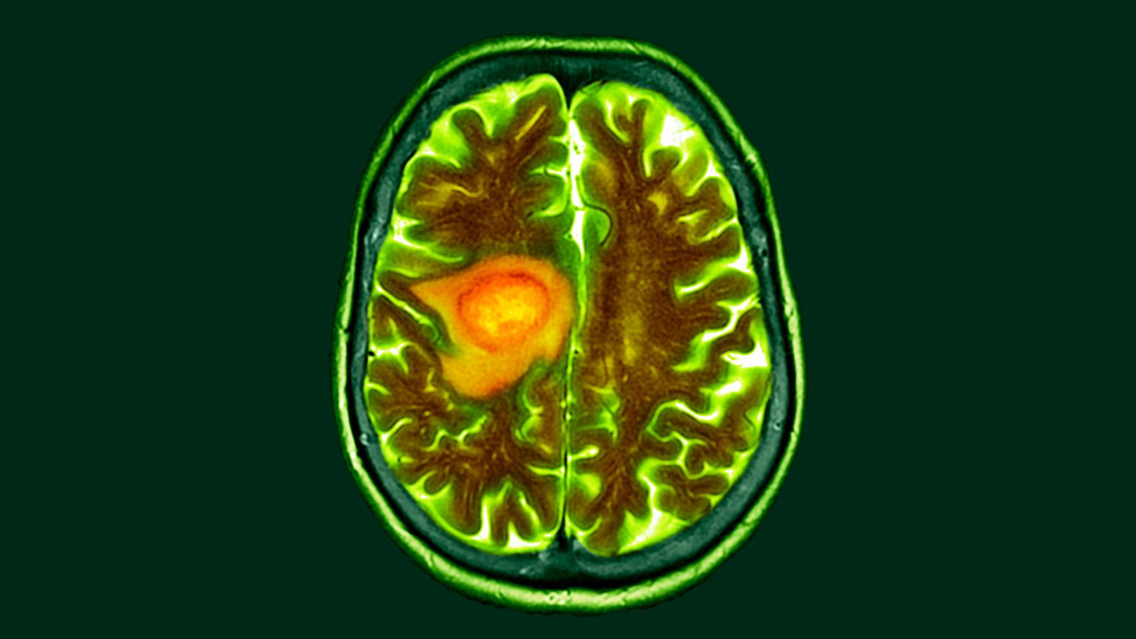 Diet change may simplify brain cancer treatment, early study suggests