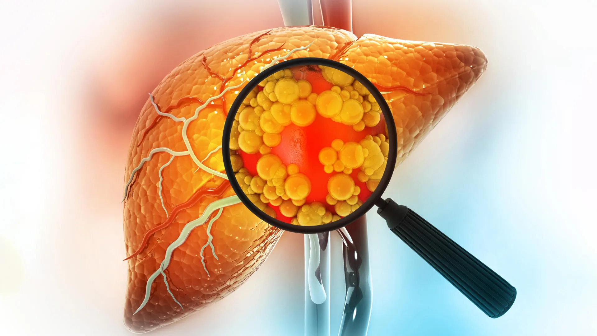 New study uncovers unexpected factors impacting fatty liver disease survival rates