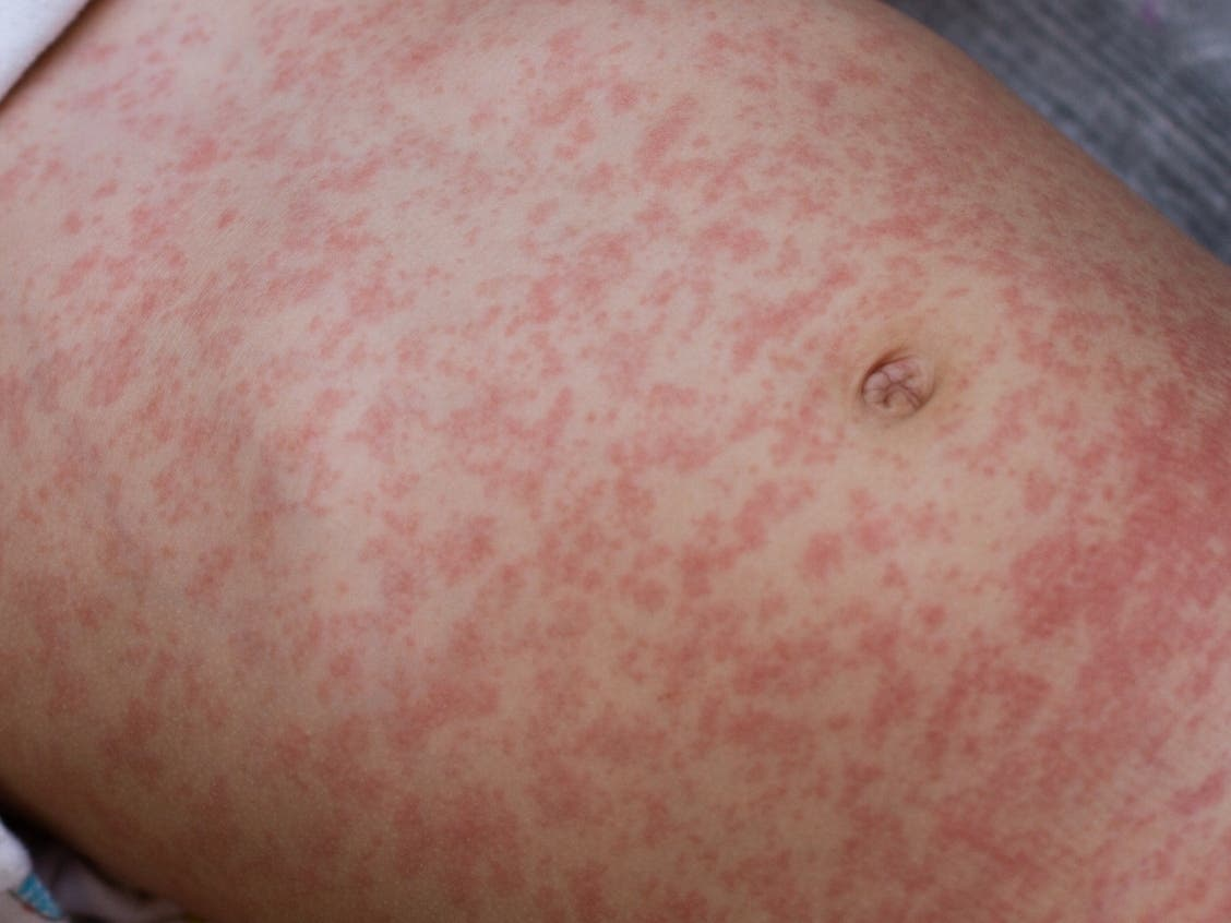 Second suburban measles case in Cook County; possible exposure at O'Hare Airport. Stay alert!
