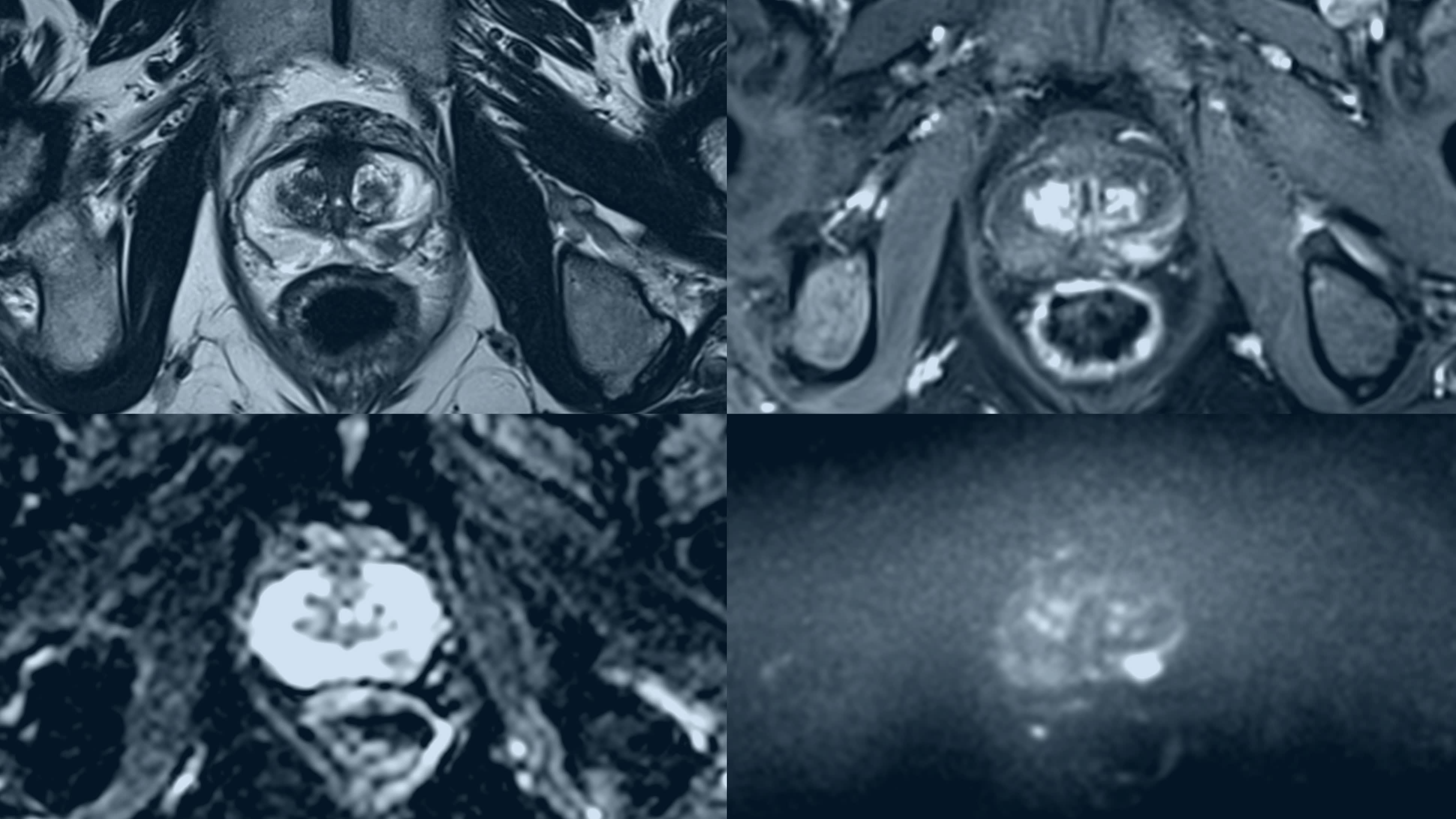 Study reveals shorter, cost-effective scans can effectively detect prostate cancer